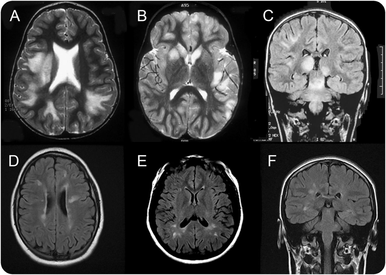 rheumatoid arthritis narcolepsy cataplexy