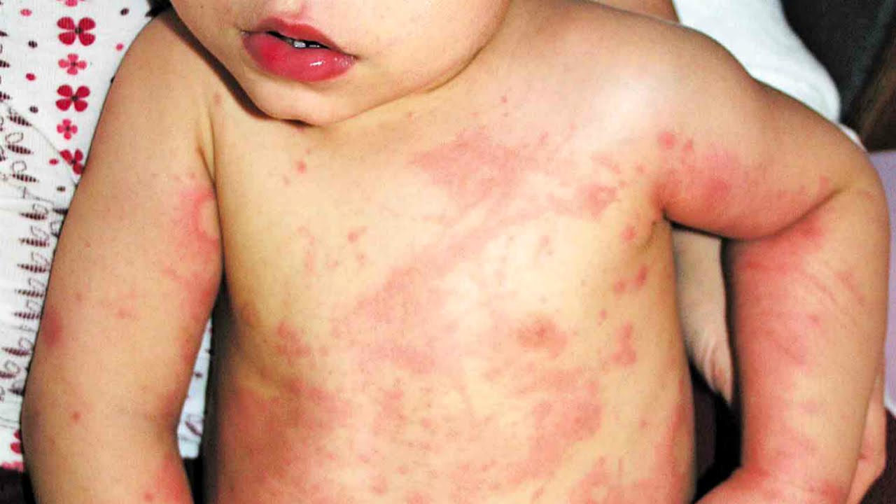 Measles Mumps Rubella What Is The MMR Vaccine   MMR 3 Rubella 