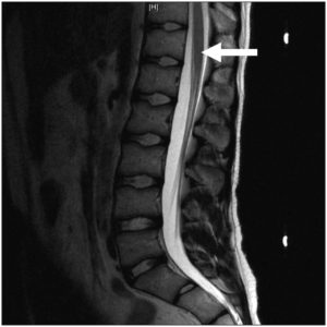 Scan of Transverse Myelitis resulting form a DTaP vaccine injury