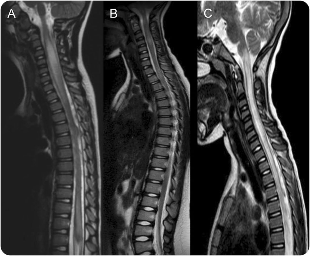 Transverse Myelitis After Vaccination